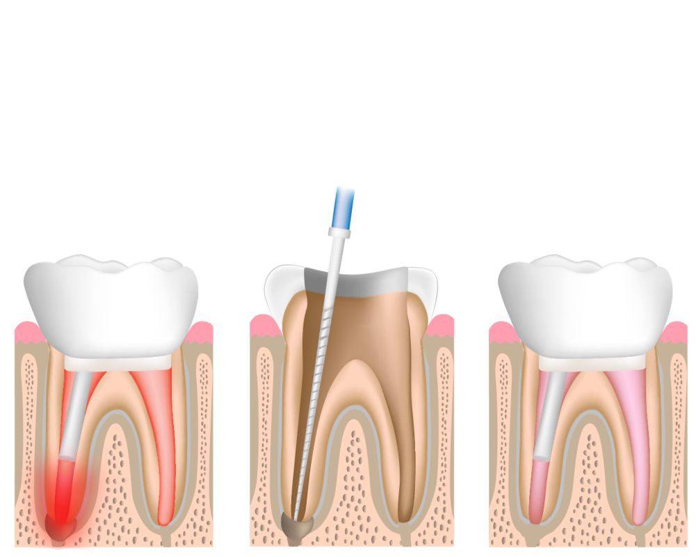 1_root_canal_2